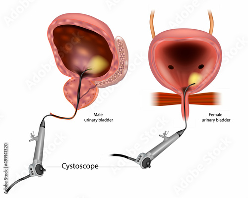 Diagram showing a Flexible cystoscopy for a man and a woman. Anatomy Male and Female Urinary Bladder. Flexible Cystoscopy - Procedure for Visually Inspecting Bladder and Urethra