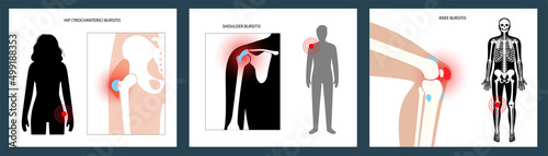 Bursitis inflammation concept