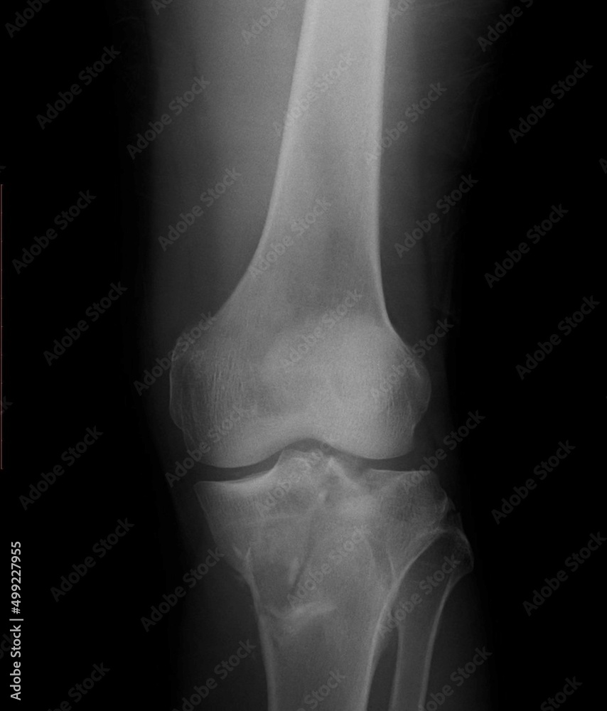 Tibial plateau fractures are break in the upper part of the shinbone (tibia) frequently associated with soft tissue injury. Tibial plateau fractures are break in the upper part of the shinbone (tibia) frequently associated with soft tissue injury.