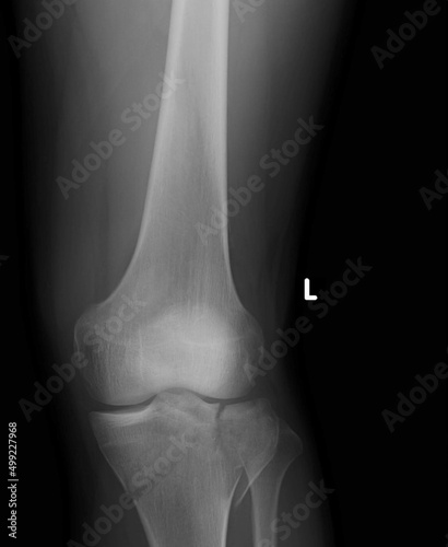 Tibial plateau fractures are break  in the upper part of the shinbone  tibia  frequently associated with soft tissue injury.