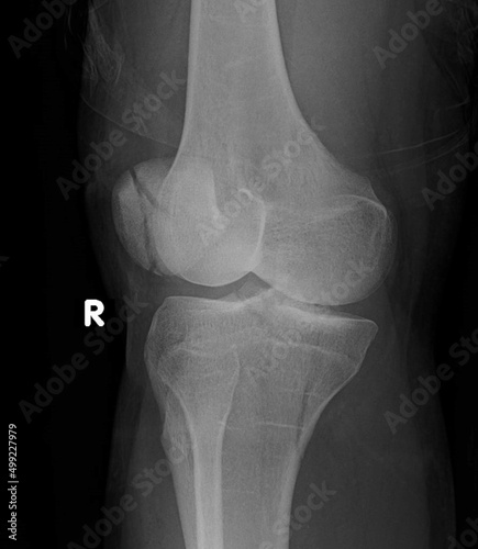 Tibial plateau fractures are break  in the upper part of the shinbone  tibia  frequently associated with soft tissue injury.