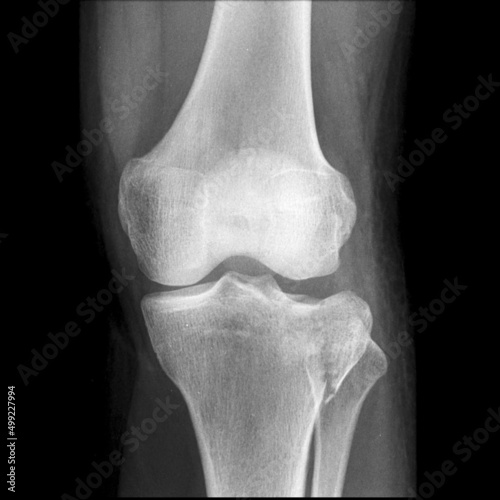 Tibial plateau fractures are break in the upper part of the shinbone (tibia) frequently associated with soft tissue injury.