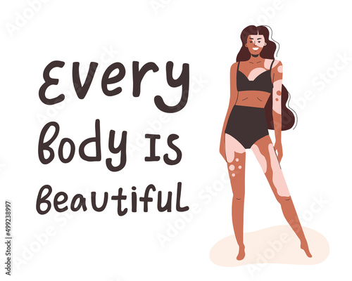 A beautiful dark-skinned girl with vitiligo disease. The woman has a lack of melanin, and she is very attractive. every body is beautiful. Flat vector illustration