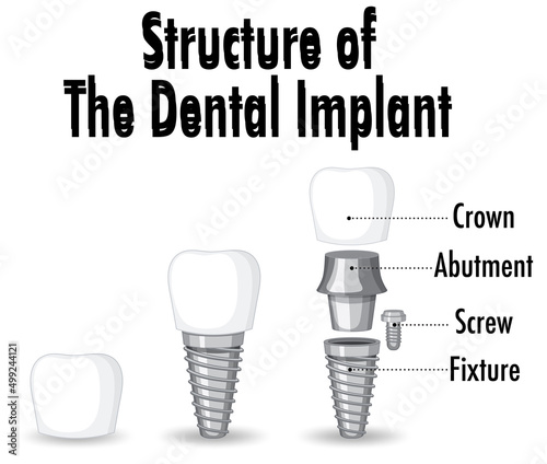 Infographic of human in structure of the dental implant