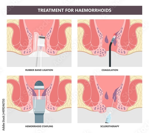 thrombectomy thrombosis fistula removal surgical Piles swollen blood anus treat band home sitz baths colon cancer examine rectum pain ligator clots stapler PPH Laser regular lump Digital anal canal