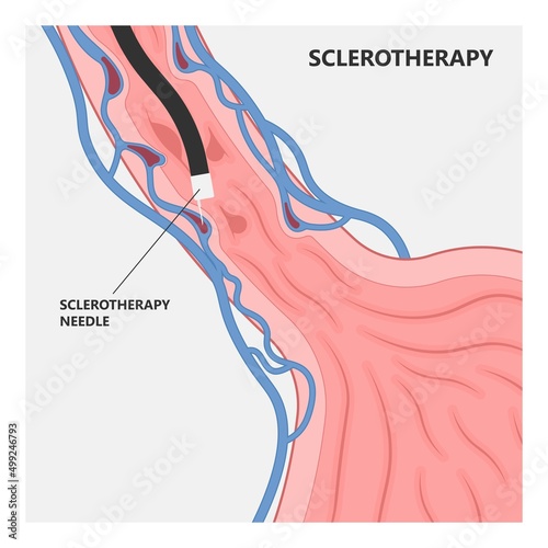 Oesophageal varicose swollen Nursing care Weiss tear upper gastric ulcer portal liver veins clot blood stools scarring A B fatty bile duct alcohol exam band variceal fibrosis GI blocked
