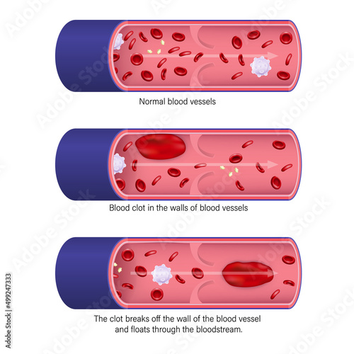 Thrombosis. Deep vein thrombosis(DVT). Embolism.