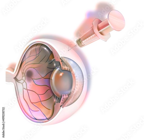 Treatment of macular degeneration by injection of RNA interference.