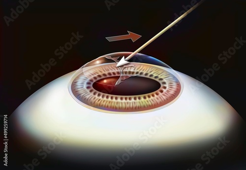 Eye surgery. Medicine laser surgery microsurgery