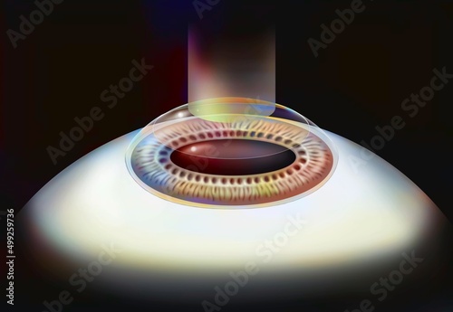 Eye surgery. Medicine laser surgery microsurgery