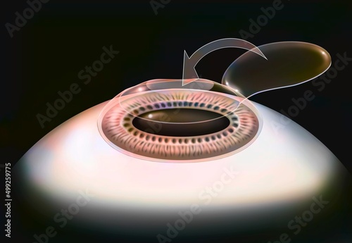 Eye surgery Lasik step 4: the corneal flap is put back in place. photo