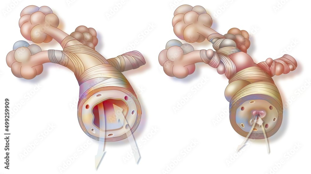 Asthma: healthy bronchiole (left) and asthmatic (right). - obrazy, fototapety, plakaty 
