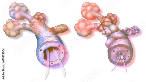 Asthma: healthy bronchiole (left) and asthmatic (right).