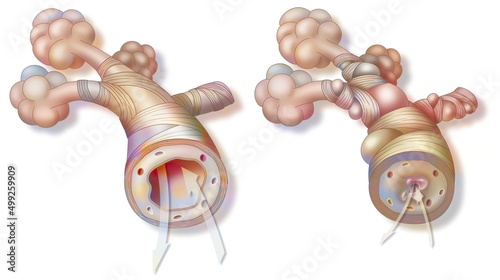 Asthma: healthy bronchiole (left) and asthmatic (right). photo