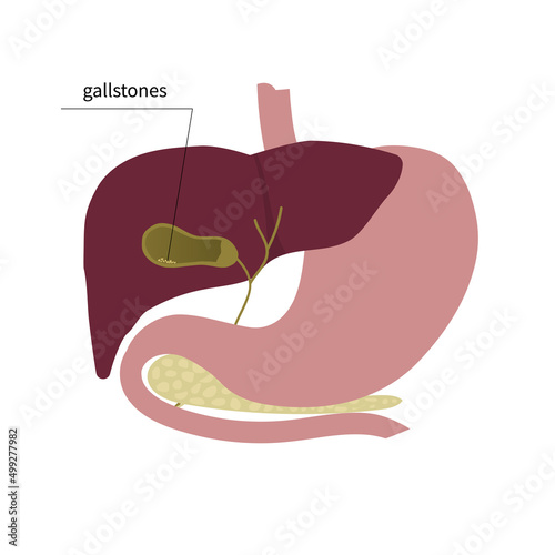 Gallstones, cholecystitis, images of the liver and gallbladder, stomach, pancreas. Vector illustration