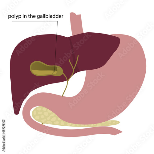 Polyp in the gallbladder, diagram, vector illustration