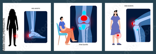 Bursitis inflammation concept