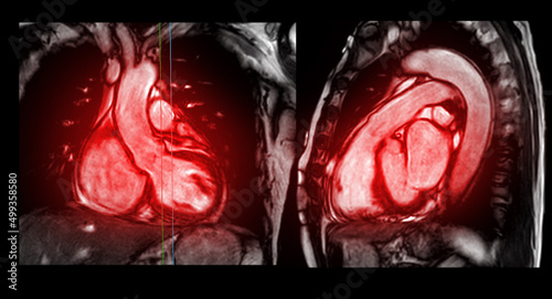 MRI heart or Cardiac MRI ( magnetic resonance imaging ) of heart compare RVOT and LVOT for diagnosis heart disease.