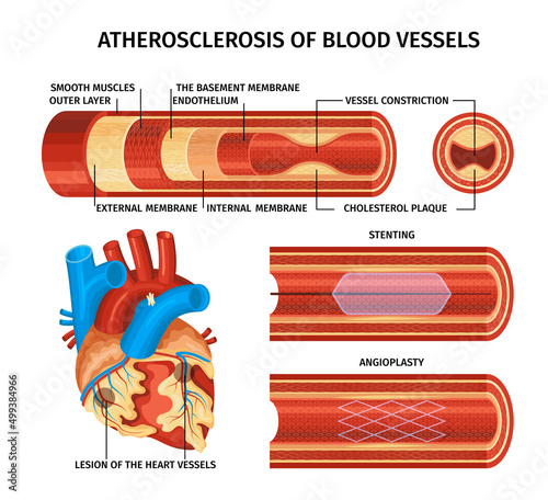 Realistic Atherosclerosis Infographic