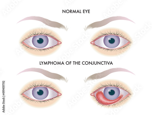 Medical illustration compares a healthy eye with one affected by lymphoma of the conjunctiva.

 photo