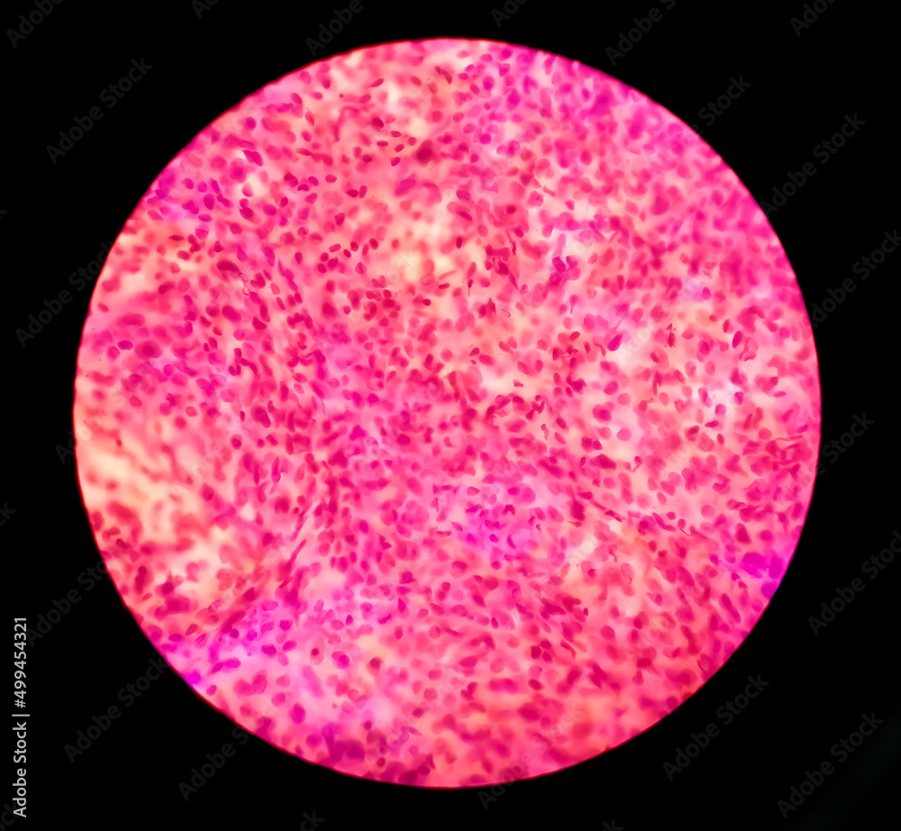 Kidney cancer: Microscopic image of clear cell carcinoma, the most common type of renal cell carcinoma. It is characterized by cytoplasmic clearing and a pattern of small branching blood vessels. Kidney cancer: Microscopic image of clear cell carcinoma, the most common type of renal cell carcinoma. It is characterized by cytoplasmic clearing and a pattern of small branching blood vessels.
