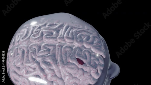 Skull with Brain Hemorrhage - AlphaBG photo