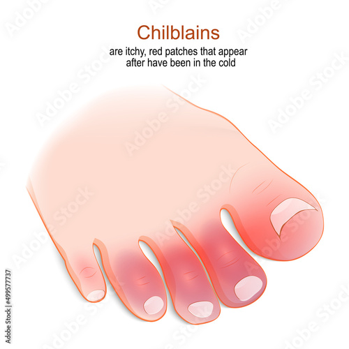 Chilblains . Humans foot with red or swollen toes.