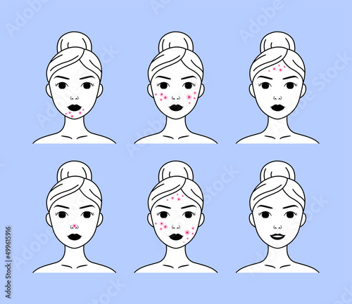 Woman with Pimples on Chin, Cheeks and Forehead. Female Face with Acne. Teenagers with Problem Skin. Healthy skin and Smile. Flat Line Contour style. Black White color. Vector image for Medical Design