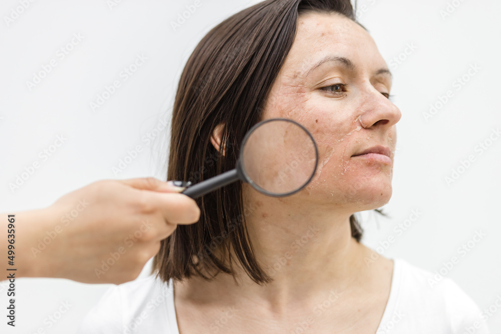 Close up photo of woman with dry skin with magnifying glass. Close up photo of woman with dry skin with magnifying glass.