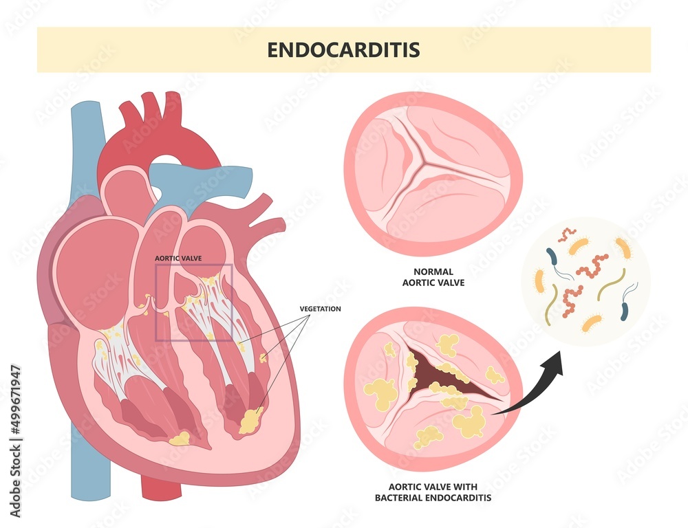 Acute aortic mitral valve bacteria fungi germs fever gum sepsis and
