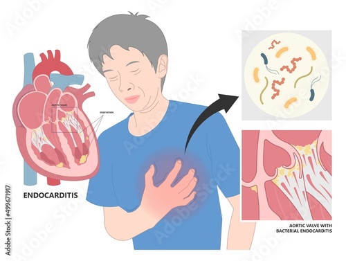 Acute aortic mitral valve bacteria fungi germs fever gum sepsis and Osler nodes insufficiency chest pain murmur sound palms hand skin rash nails eye with Roth spot