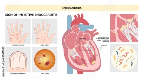 Acute aortic mitral valve bacteria fungi germs fever gum sepsis and Osler nodes insufficiency chest pain murmur sound palms hand skin rash nails eye with Roth spot photo