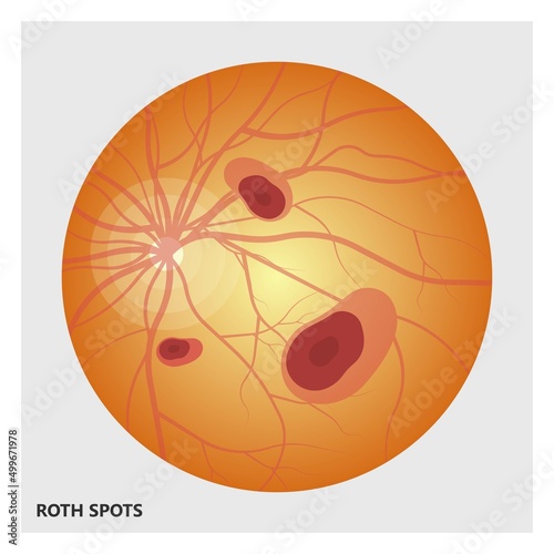 Acute aortic mitral valve bacteria fungi germs fever gum sepsis and Osler nodes insufficiency chest pain murmur sound palms hand skin rash nails eye with Roth spot