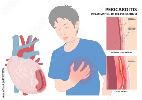 Heart attack acute chest pain injury difficulty breathing fat pads trauma fever shock viral bacterial fungal rate mRNA COVID-19 muscle dyspnea arrest unstable angina X-RAY diagnose Lupus virus cancer