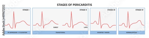 Heart attack acute chest pain injury difficulty breathing fat pads trauma fever shock viral bacterial fungal rate mRNA COVID-19 muscle dyspnea arrest unstable angina X-RAY diagnose Lupus virus cancer