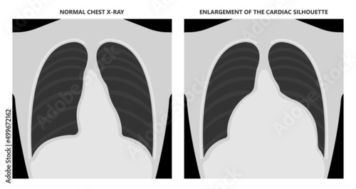 Heart attack acute chest pain injury difficulty breathing fat pads trauma fever shock viral bacterial fungal rate mRNA COVID-19 muscle dyspnea arrest unstable angina X-RAY diagnose Lupus virus cancer