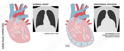 Heart attack acute chest pain injury difficulty breathing fat pads trauma fever shock viral bacterial fungal rate mRNA COVID-19 muscle dyspnea arrest unstable angina X-RAY diagnose Lupus virus cancer photo