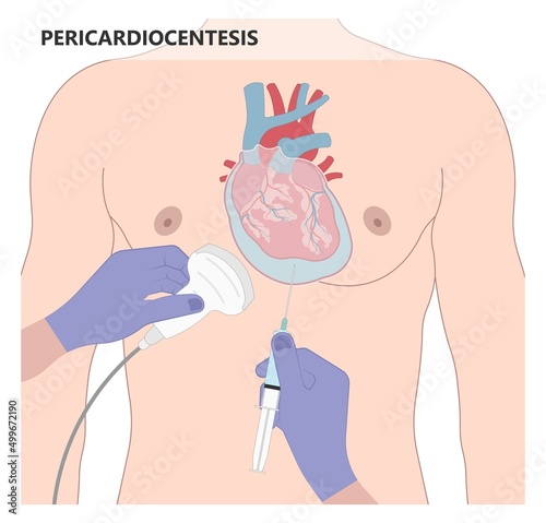 Heart attack acute chest pain injury difficulty breathing fat pads trauma fever shock viral bacterial fungal rate mRNA COVID-19 muscle dyspnea arrest unstable angina X-RAY diagnose Lupus virus cancer