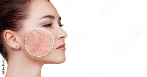 Young woman with couperose on face skin in zoom circle. photo