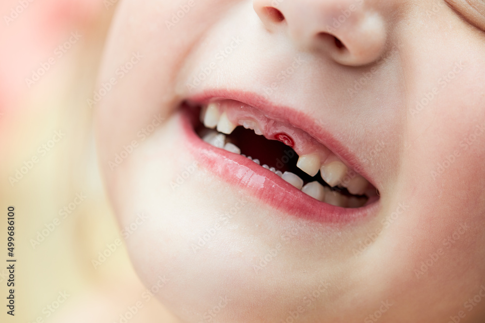 Naklejka premium A little girl lost her baby milk tooth. Lost temporary tooth. The concept of oral hygiene in children. Close-up of the oral cavity