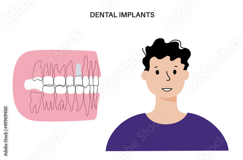 Dental implant procedure