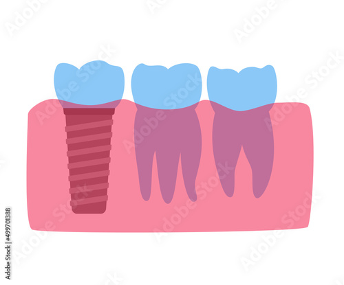 Dental implant procedure