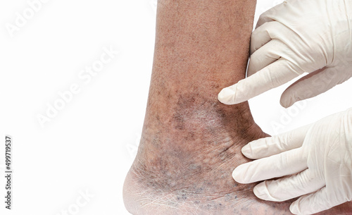 Doctor in white gloves holding man's foot and pointing to varicose veins, deep vein thrombosis, venous injuries on foot. Healthy varicose ulcer. Isolated on white background.