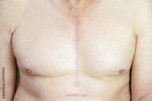 Obraz na płótnie Shirtless Caucasian man with scar mark from CABG (Coronary Artery Bypass Graft) on his chest