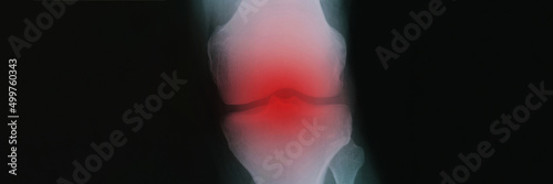Photos X ray with red inflammation of knee joint closeup