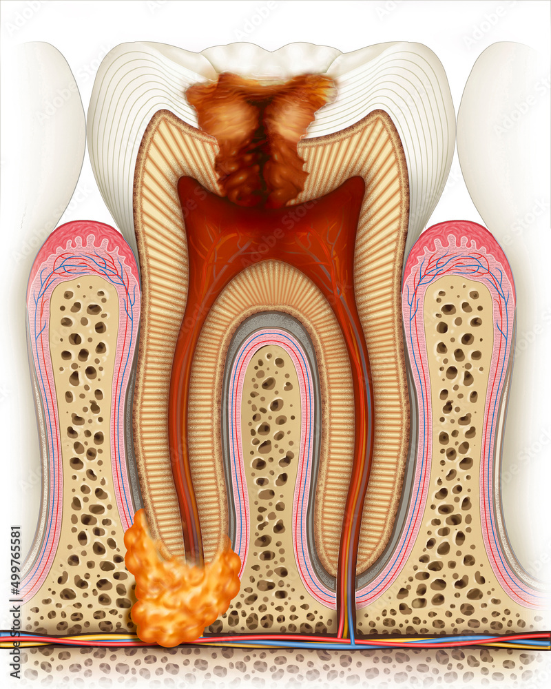 Destrucción de una muela por carie en estado avanzado. Stock