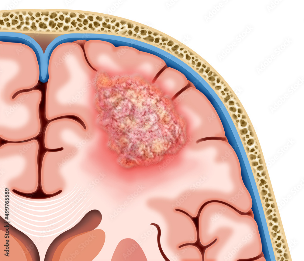 Ilustración descriptiva de un tumor cerebral, esta masa o bulto de células anormales afectará el funcionamiento del sistema nervioso.  - obrazy, fototapety, plakaty 