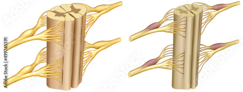 Ilustración de la médula espinal sana y con la enfermedad de Ataxia. La ataxia es la falta de control muscular o de coordinación de los movimientos voluntarios, como caminar o recoger objetos. photo