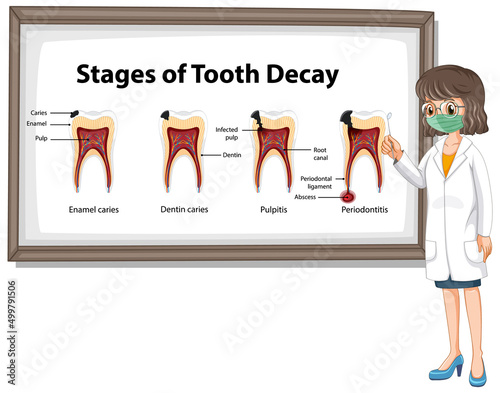 Infographic of human in the stages of tooth decay