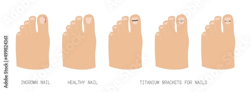 Treatment of ingrown toenail with titanium brackets different types. Hand drawn vector illustration